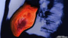 m14_023 Herzinfarkt mit sichtbarer Nekrose in linker Rntgenansicht