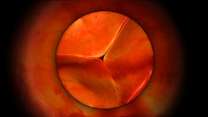 m14_024 Gewebe einer geschlossenen Herzklappe (Aortenklappe)