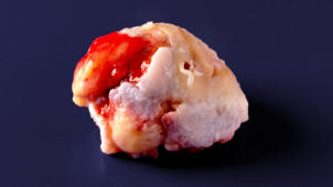 m01_037 Im OP entfernter Hftgelenkskopf mit schwerer Kox-Arthrose