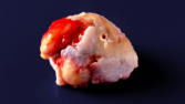m01_037 Im OP entfernter Hftgelenkskopf mit schwerer Kox-Arthrose